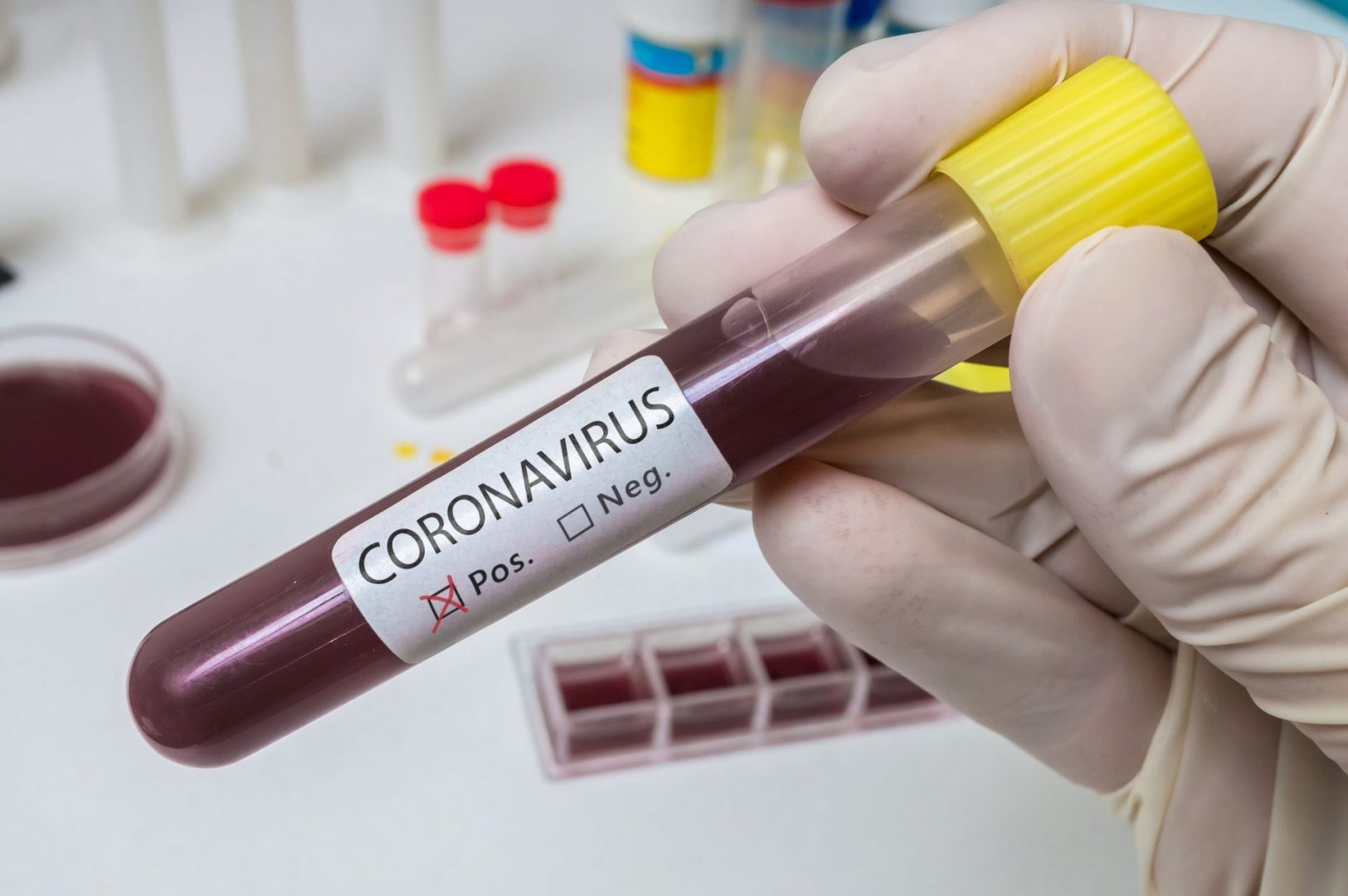 coronavirus blood test scaled Coronavírus: New Jersey já tem 44 vítimas fatais
